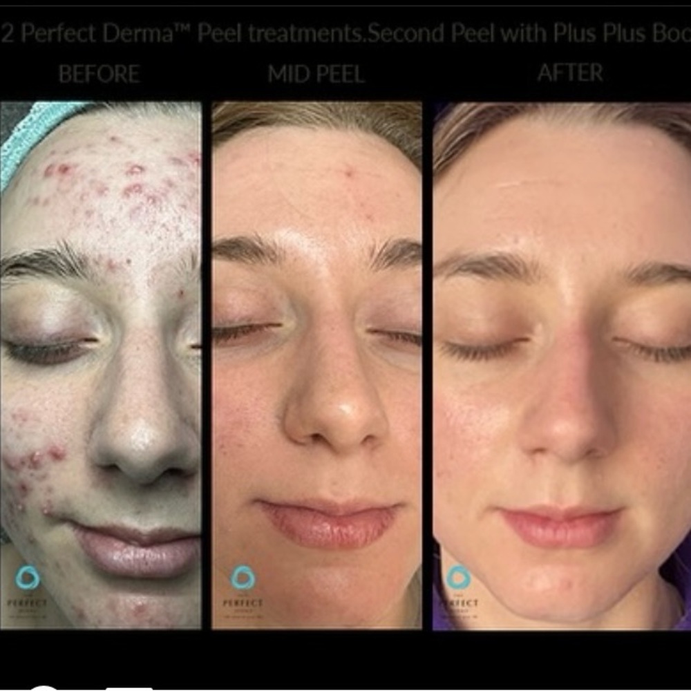 THE PERFECT DERMA™ PEEL